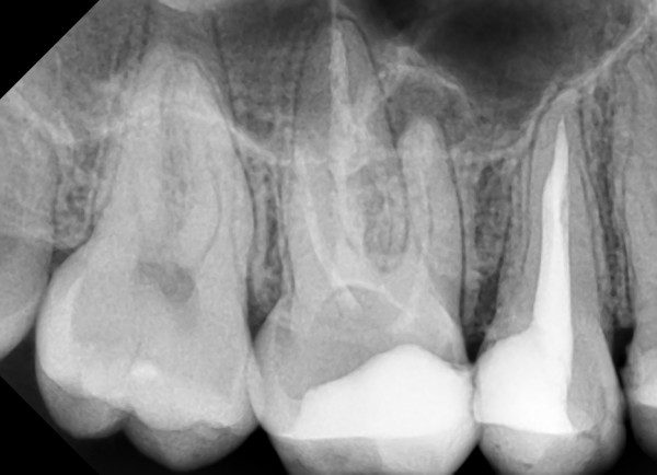 Лечение кисты и гранулемы зуба
