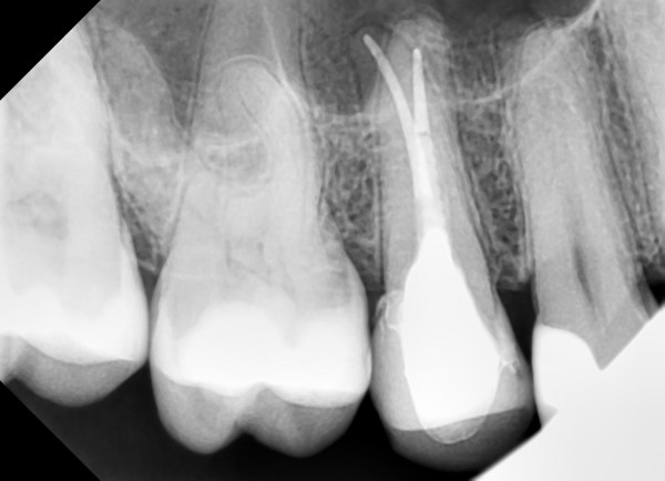 Лечение каналов