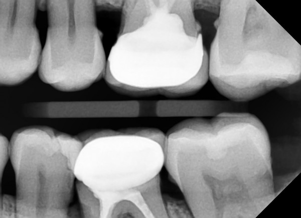 Реставрация зубов
